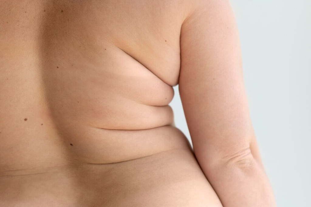 how to remove back fat​