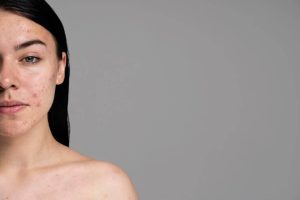 mesotherapy for acne scars