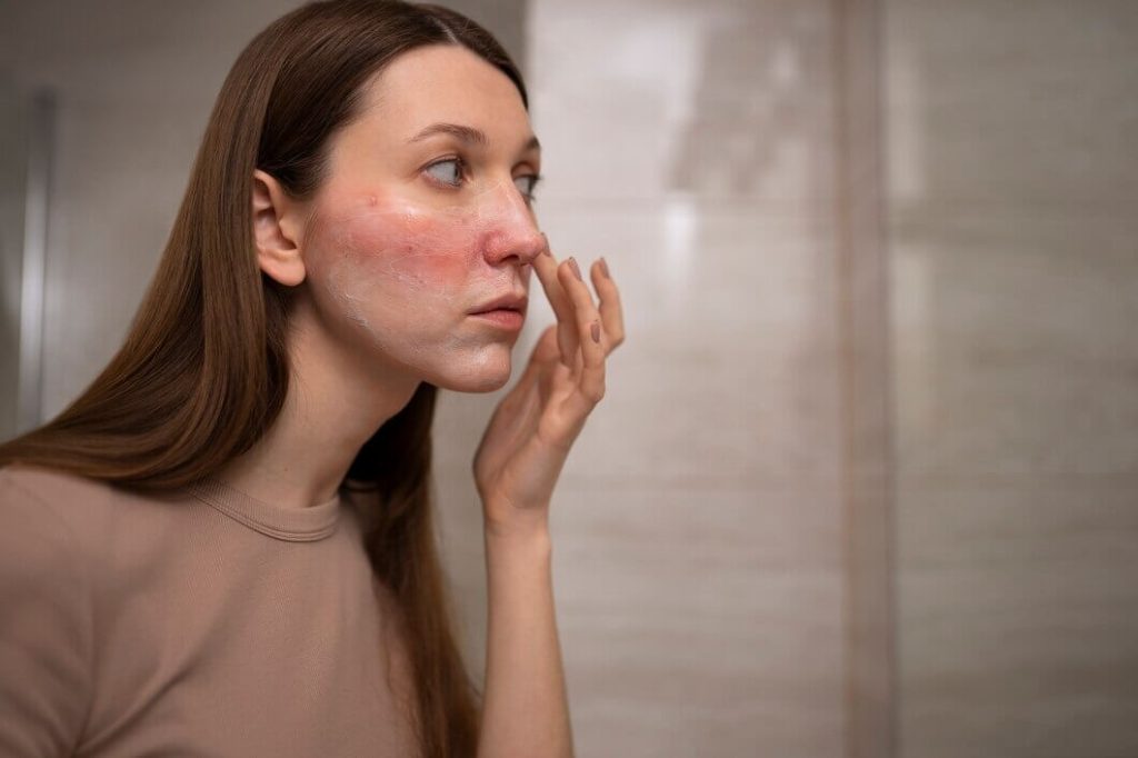 ​mesotherapy for rosacea
